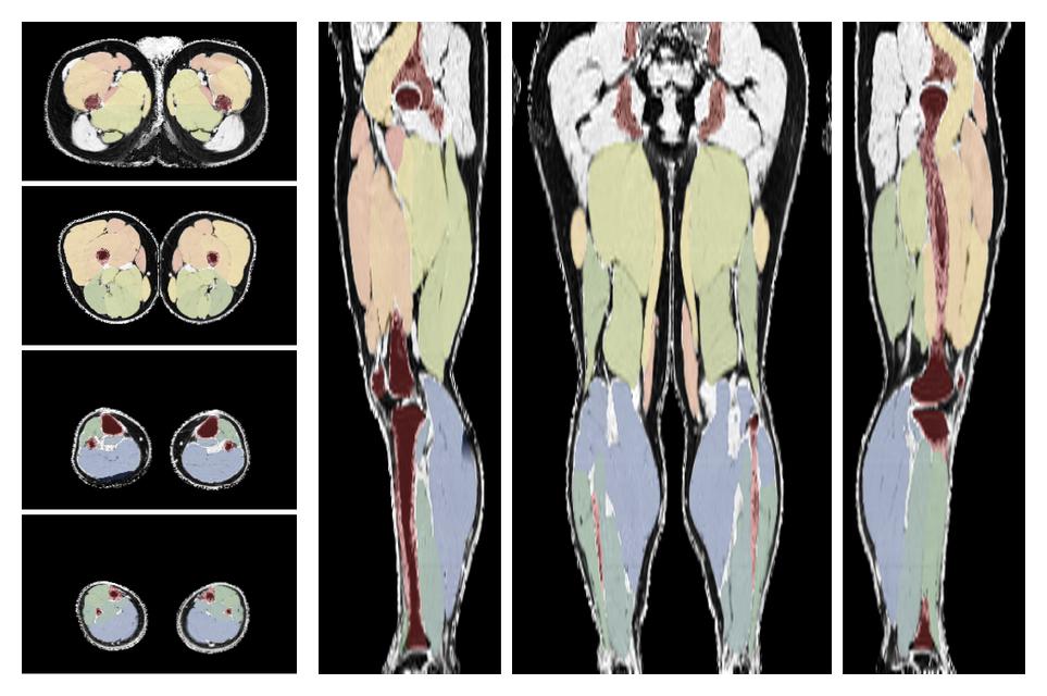 Overlay of automated muscle segmentation labels on dixon water image.