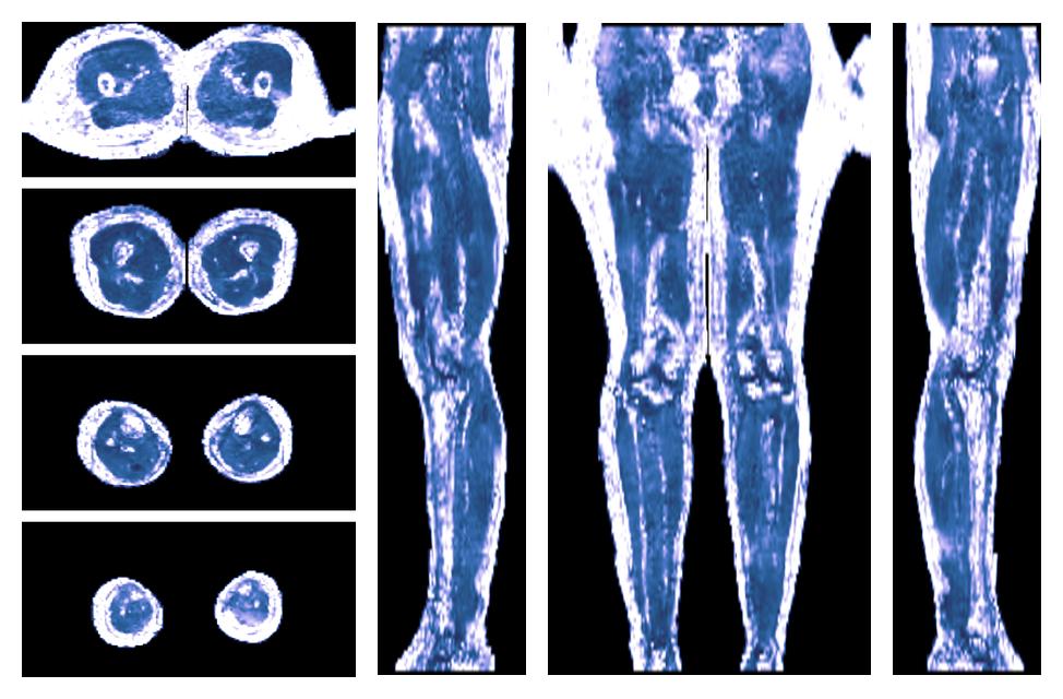 IVIM corrected whole leg muscle fractional anisotropy obtained from diffusion tensor imaging.