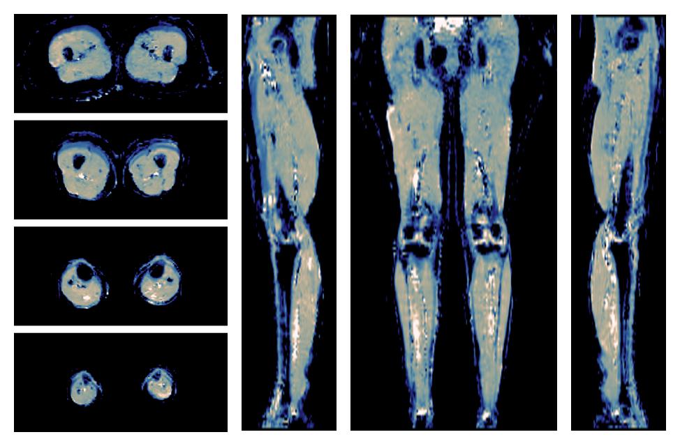 IVIM corrected whole leg muscle mean diffusivity obtained from diffusion tensor imaging.