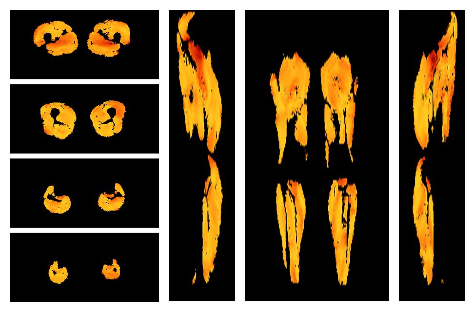 Muscle fiber tract angle map based on whole leg DTI based fiber tractography.