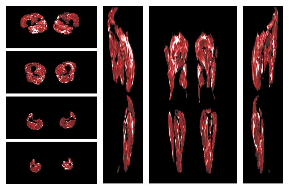 Muscle fiber tract density map based on whole leg DTI based fiber tractography.