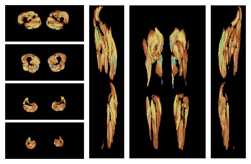 Muscle fiber tract length map based on whole leg DTI based fiber tractography.