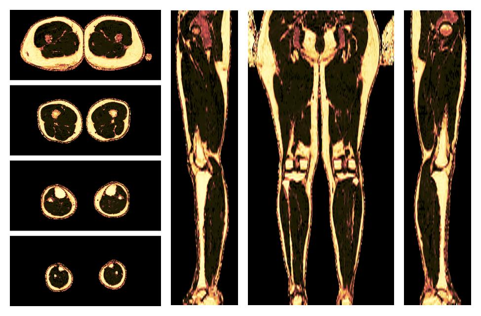 The fat fraction of the lower extremity obtained from the dixon reconstruction for muscle water fat quantification.