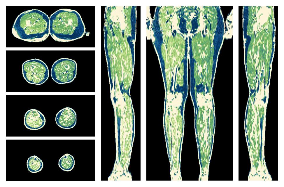 The R2 star relaxation time of the lower extremity obtained from the dixon reconstruction for muscle water fat quantification.