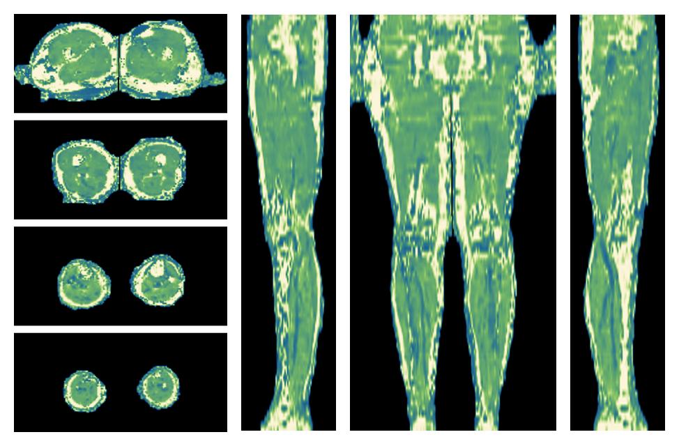 The water only T2 relaxation time of the lower extremity obtained from multi echo spin echo t2 mapping with EPG based reconstruction.