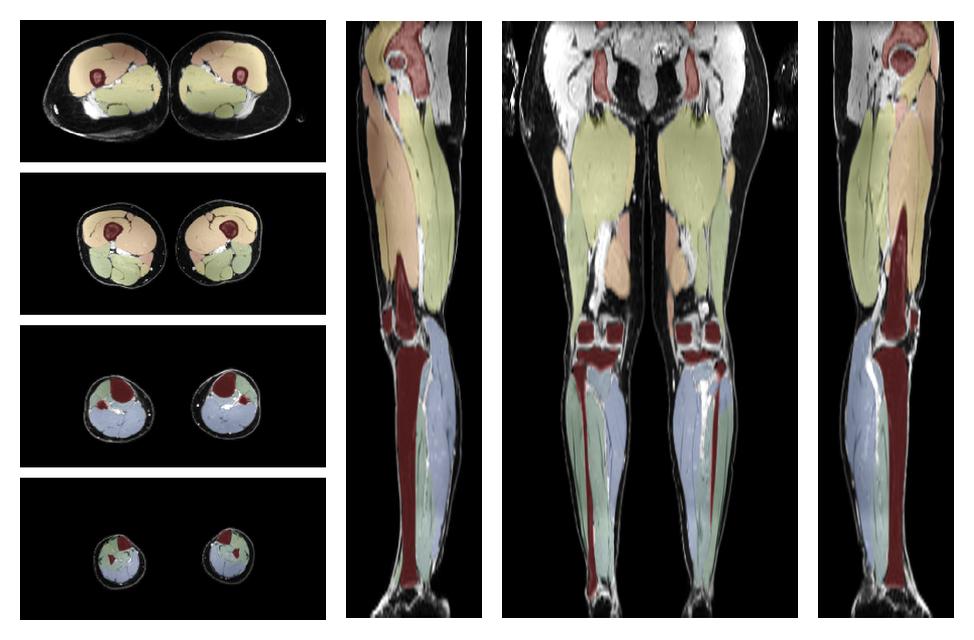 Overlay of automated muscle segmentation labels on dixon water image.