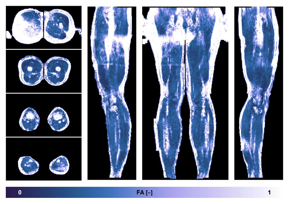 IVIM corrected whole leg muscle fractional anisotropy obtained from diffusion tensor imaging.