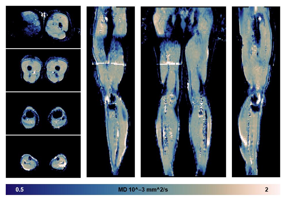 IVIM corrected whole leg muscle mean diffusivity obtained from diffusion tensor imaging.