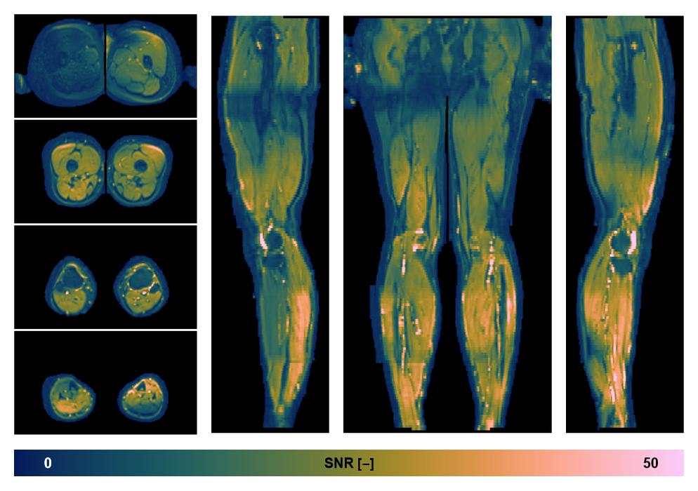 SNR distribution of the unweighted diffusion data.