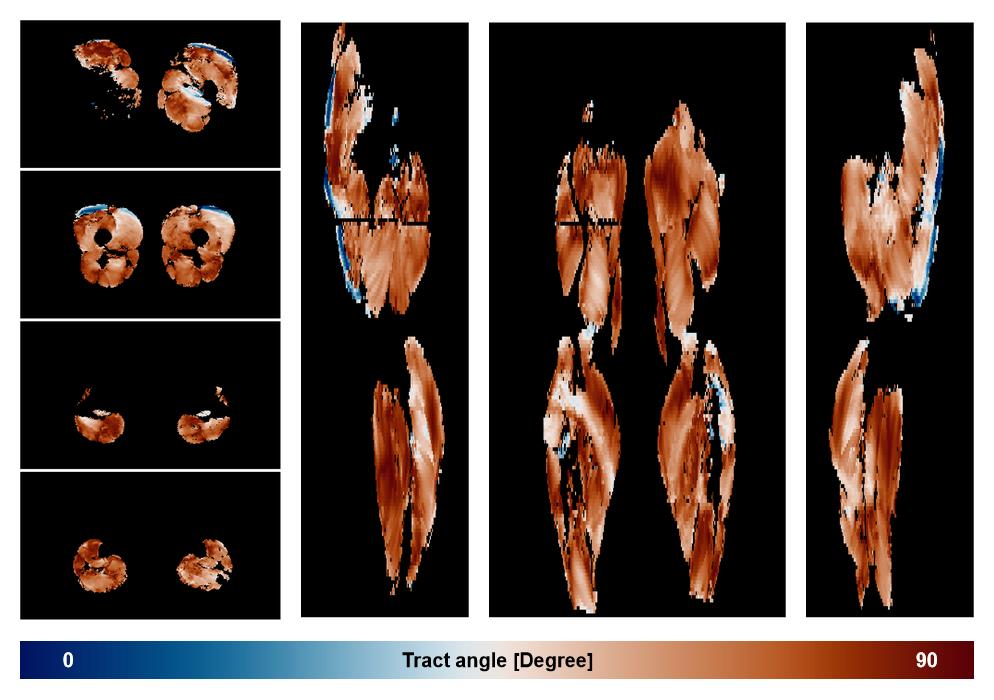 Muscle fiber tract angle map based on whole leg DTI based fiber tractography.