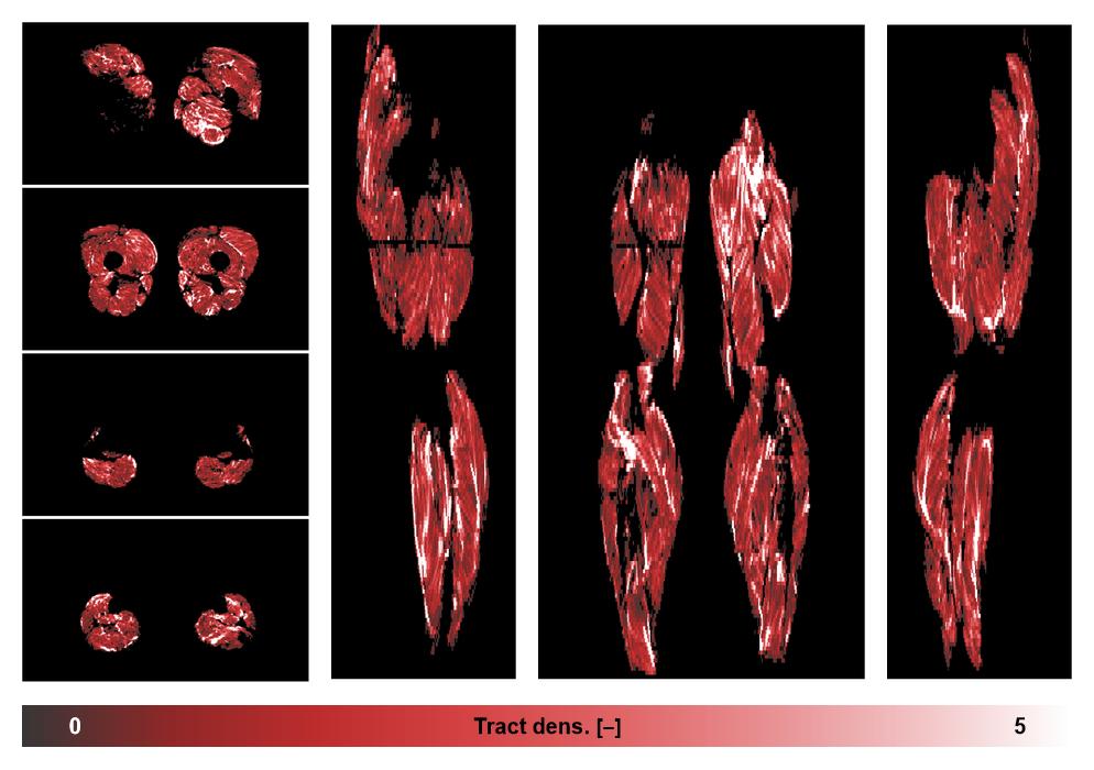 Muscle fiber tract density map based on whole leg DTI based fiber tractography.