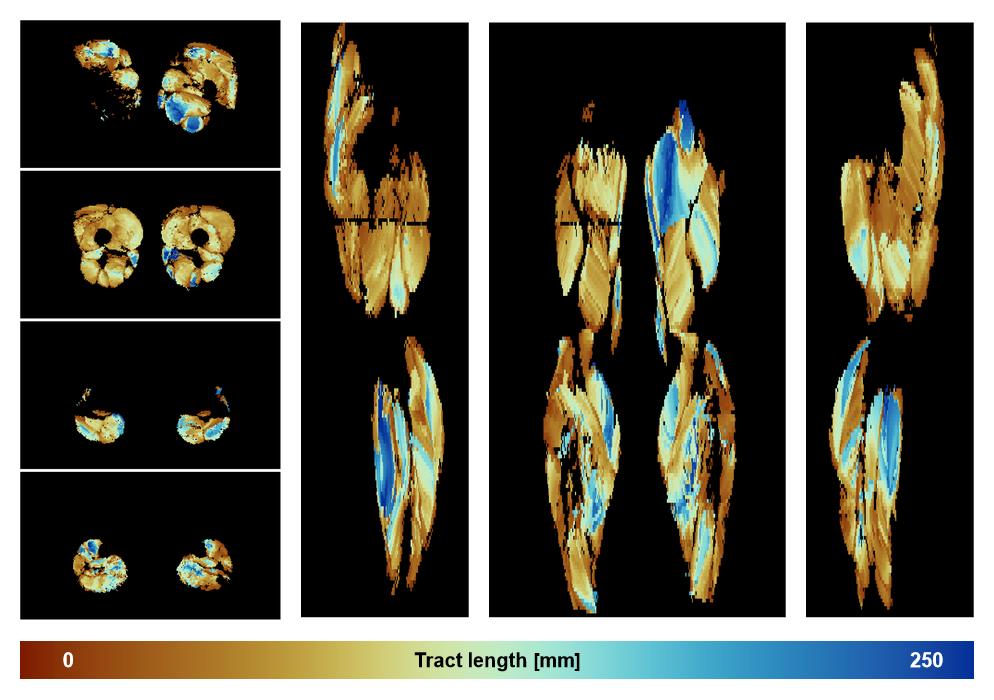 Muscle fiber tract length map based on whole leg DTI based fiber tractography.