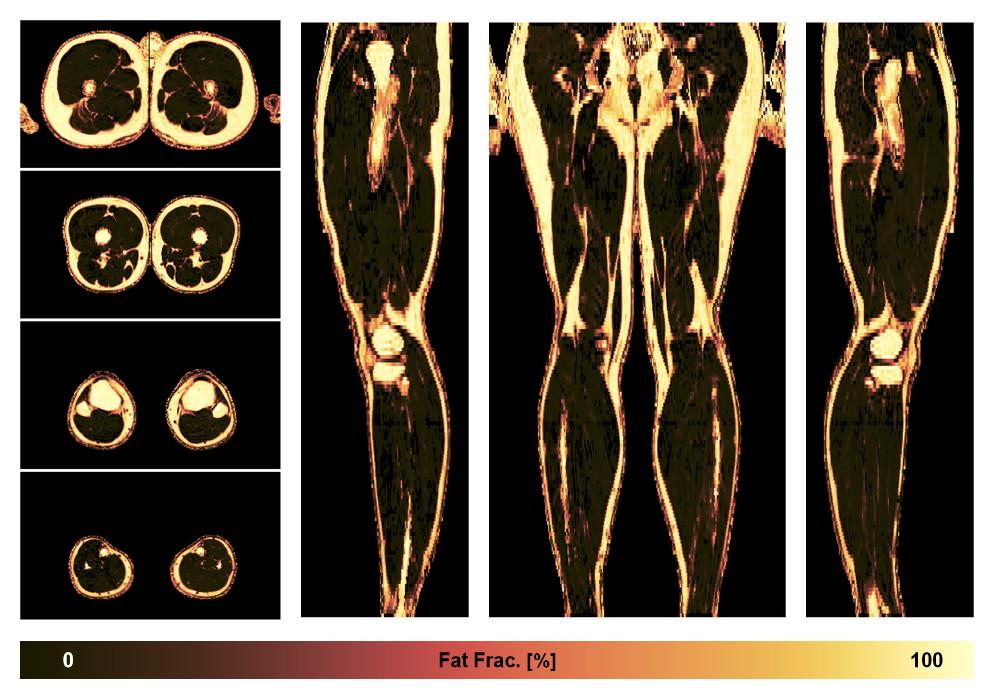 The fat fraction of the lower extremity obtained from the dixon reconstruction for muscle water fat quantification.