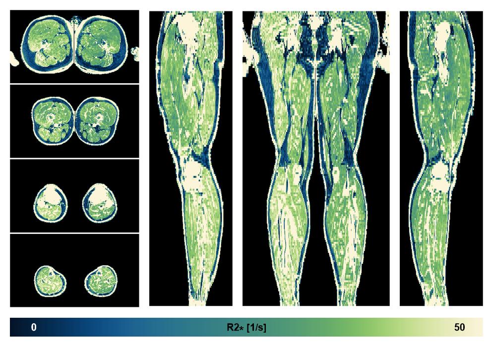 The R2 star relaxation time of the lower extremity obtained from the dixon reconstruction for muscle water fat quantification.