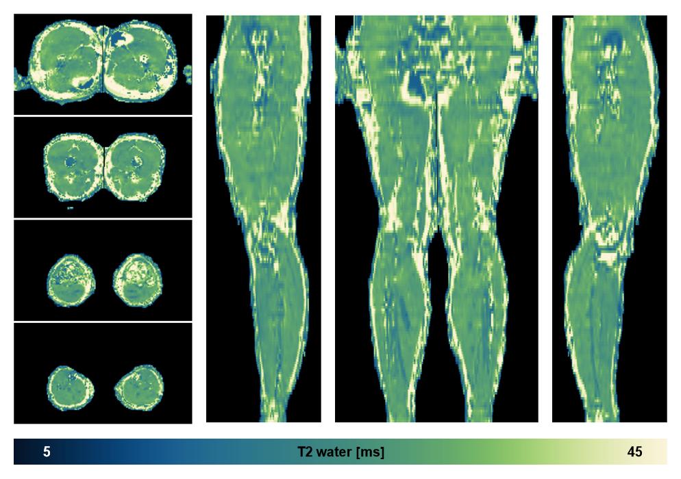 The water only T2 relaxation time of the lower extremity obtained from multi echo spin echo t2 mapping with EPG based reconstruction.