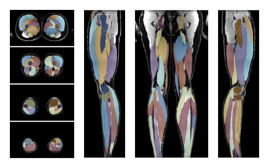 Overlay of automated muscle segmentation labels on dixon water image.