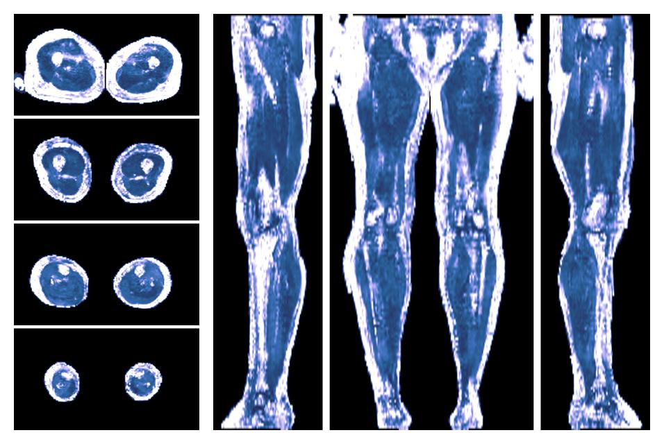 IVIM corrected whole leg muscle fractional anisotropy obtained from diffusion tensor imaging.