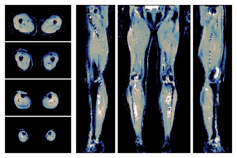 IVIM corrected whole leg muscle mean diffusivity obtained from diffusion tensor imaging.