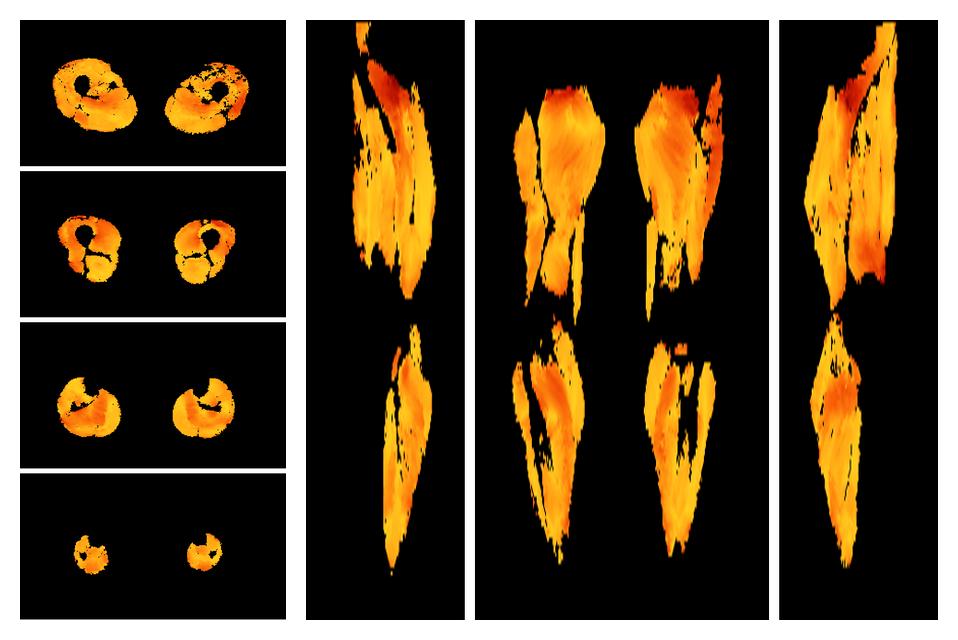 Muscle fiber tract angle map based on whole leg DTI based fiber tractography.