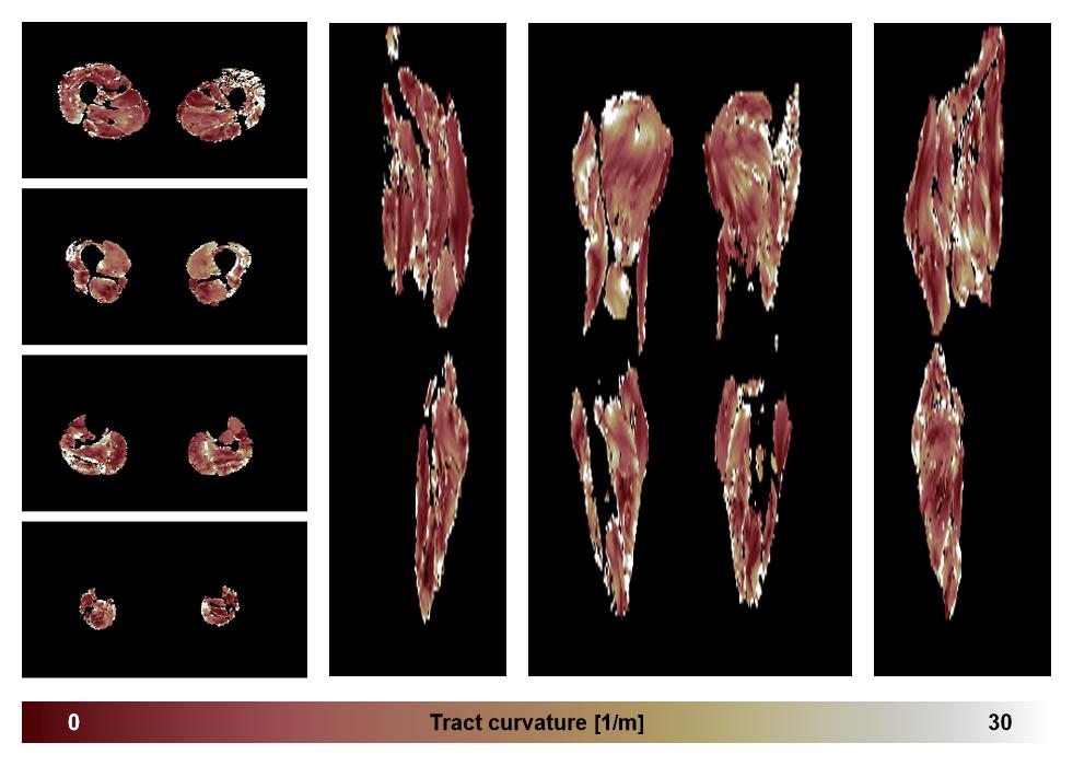 Muscle fiber tract curvature map based on whole leg DTI based fiber tractography.