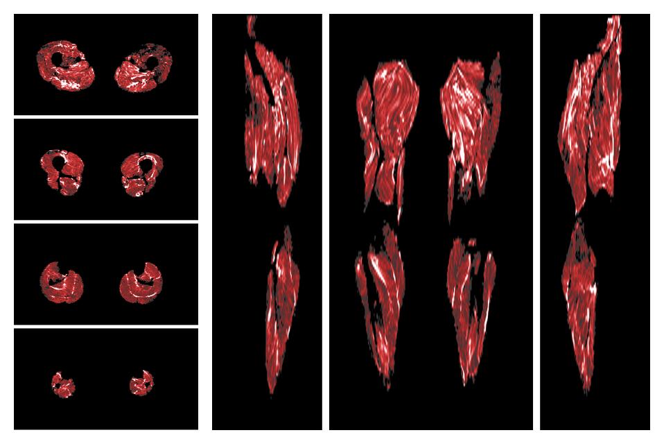 Muscle fiber tract density map based on whole leg DTI based fiber tractography.