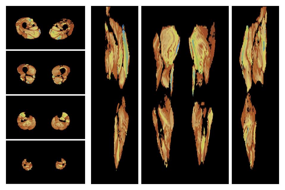 Muscle fiber tract length map based on whole leg DTI based fiber tractography.