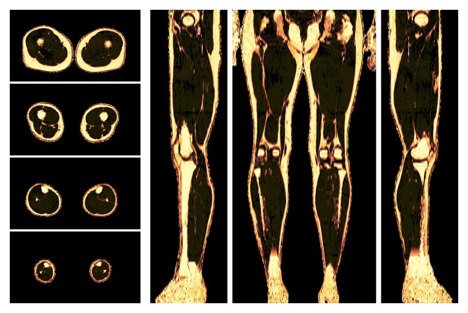 The fat fraction of the lower extremity obtained from the dixon reconstruction for muscle water fat quantification.