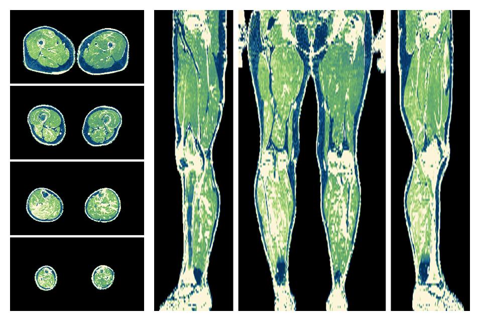 The R2 star relaxation time of the lower extremity obtained from the dixon reconstruction for muscle water fat quantification.