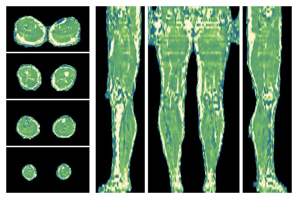 The water only T2 relaxation time of the lower extremity obtained from multi echo spin echo t2 mapping with EPG based reconstruction.