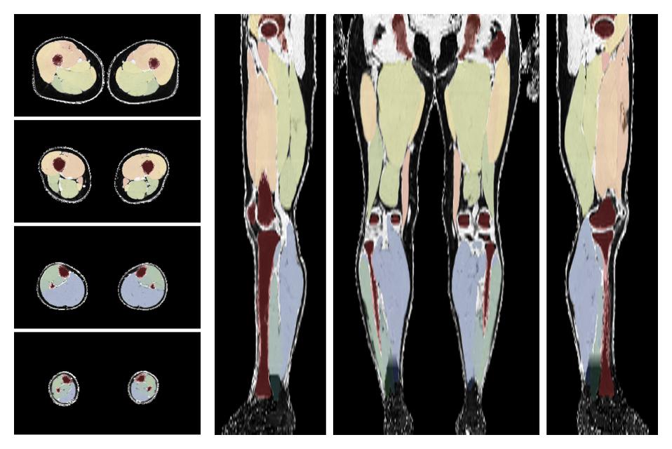 Overlay of automated muscle segmentation labels on dixon water image.