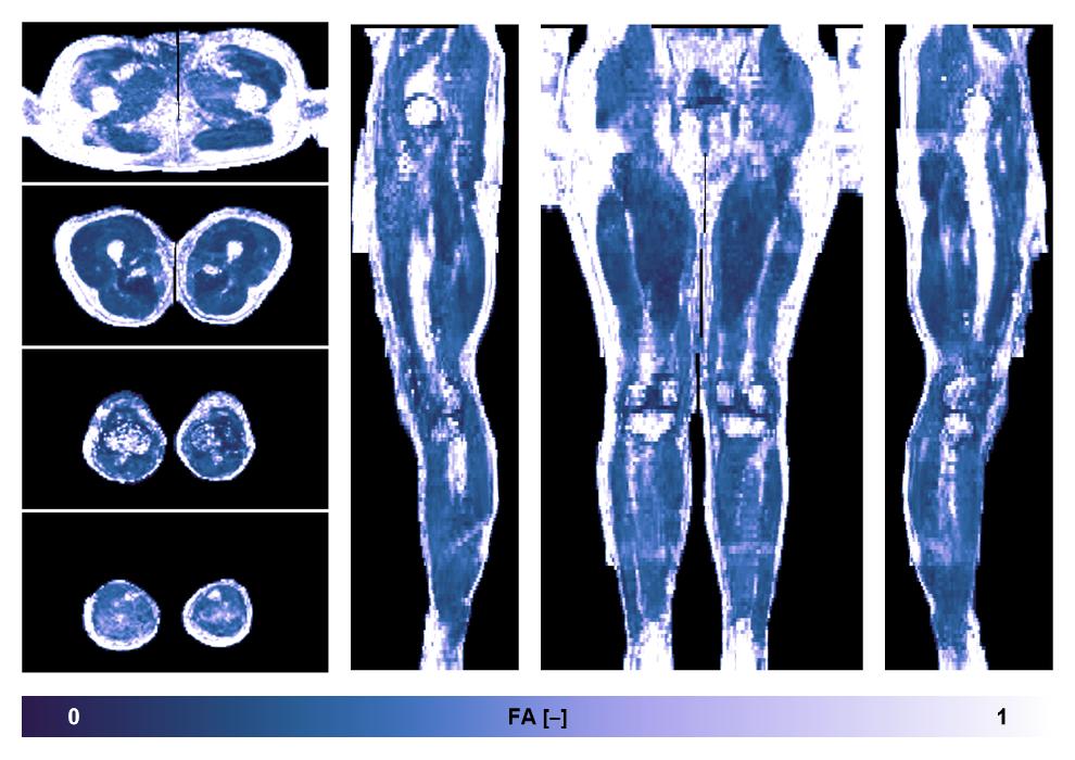 IVIM corrected whole leg muscle fractional anisotropy obtained from diffusion tensor imaging.