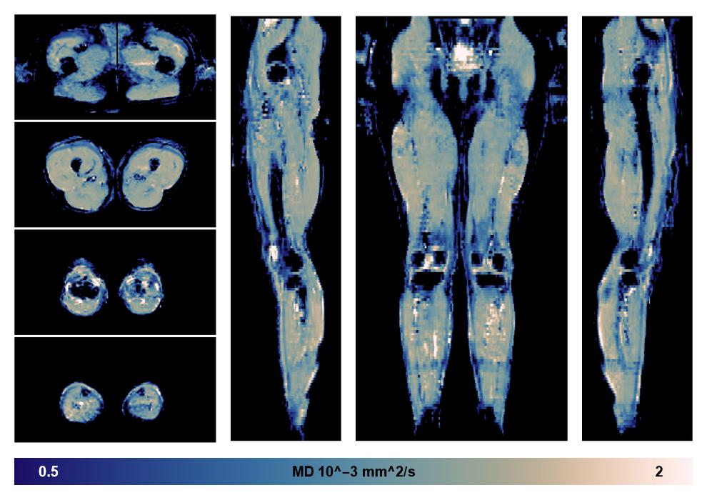 IVIM corrected whole leg muscle mean diffusivity obtained from diffusion tensor imaging.