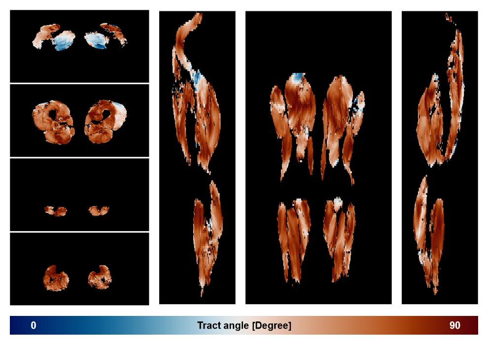 Muscle fiber tract angle map based on whole leg DTI based fiber tractography.