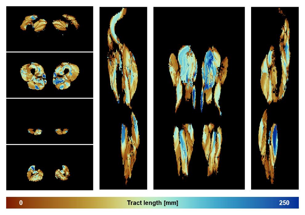 Muscle fiber tract length map based on whole leg DTI based fiber tractography.