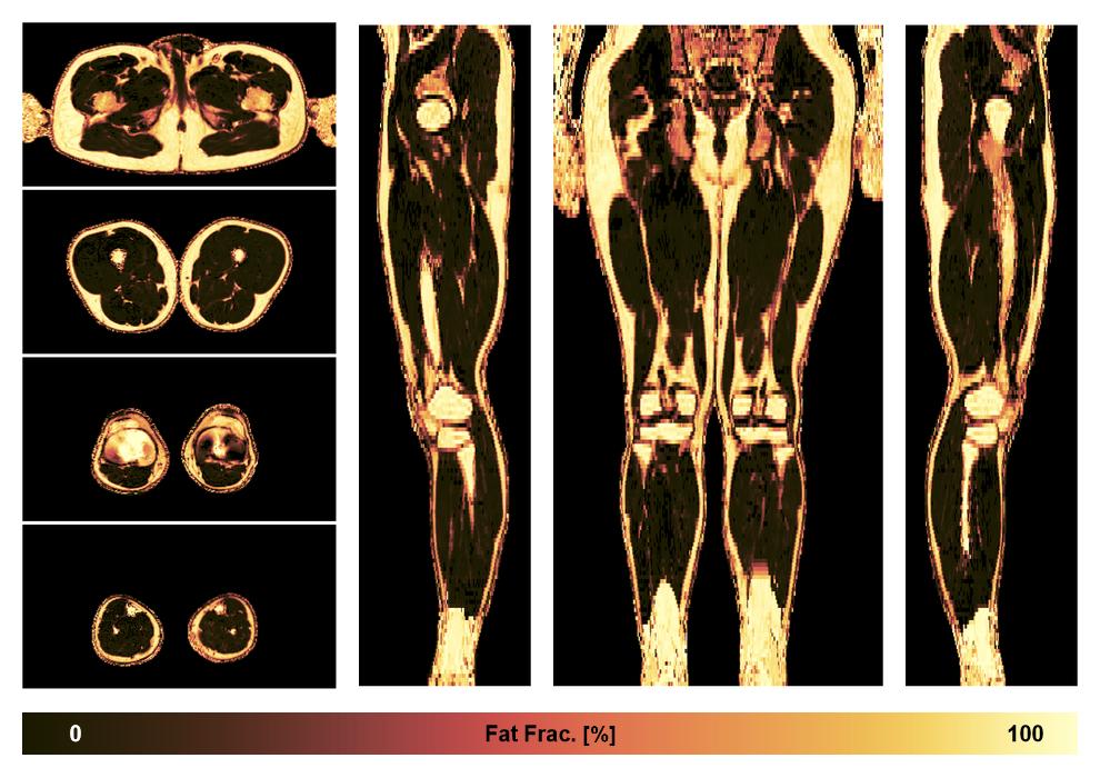 The fat fraction of the lower extremity obtained from the dixon reconstruction for muscle water fat quantification.