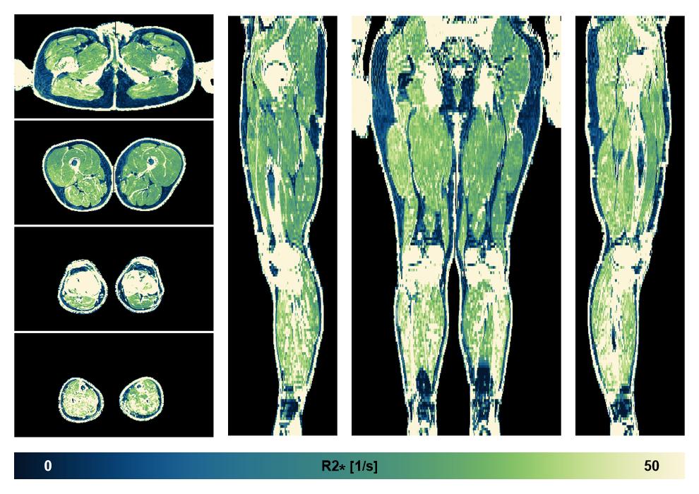 The R2 star relaxation time of the lower extremity obtained from the dixon reconstruction for muscle water fat quantification.