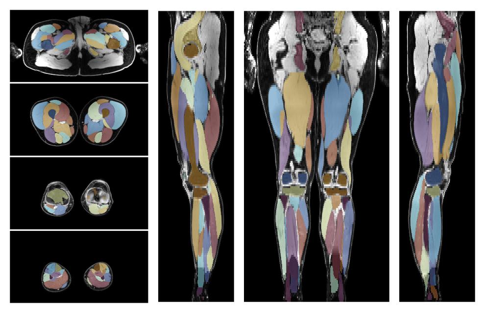 Overlay of automated muscle segmentation labels on dixon water image.