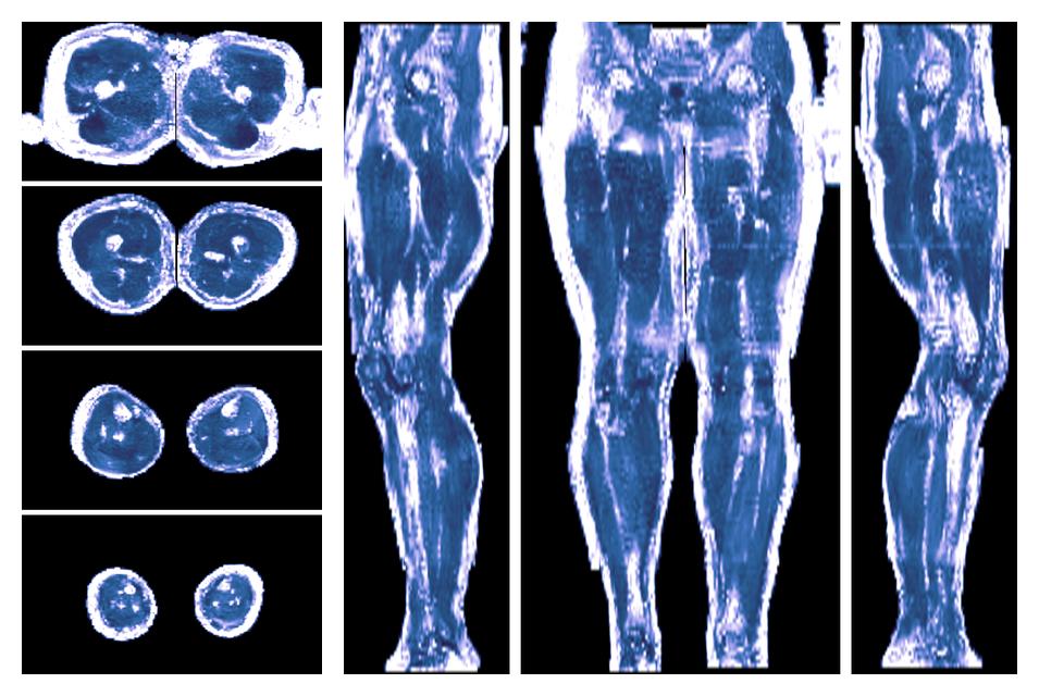 IVIM corrected whole leg muscle fractional anisotropy obtained from diffusion tensor imaging.