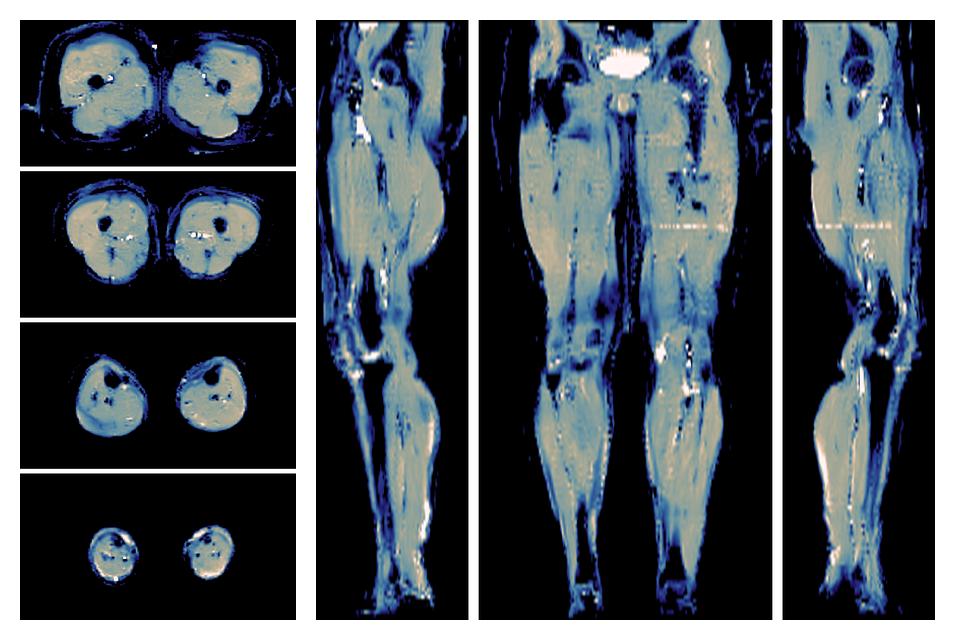 IVIM corrected whole leg muscle mean diffusivity obtained from diffusion tensor imaging.