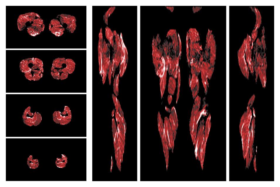 Muscle fiber tract density map based on whole leg DTI based fiber tractography.