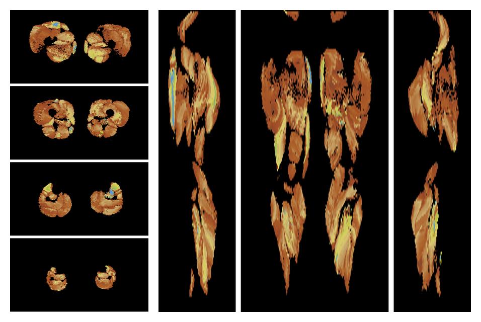 Muscle fiber tract length map based on whole leg DTI based fiber tractography.