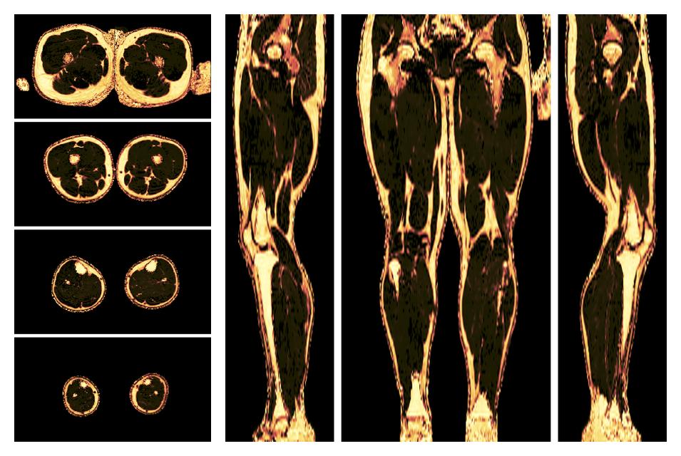 The fat fraction of the lower extremity obtained from the dixon reconstruction for muscle water fat quantification.