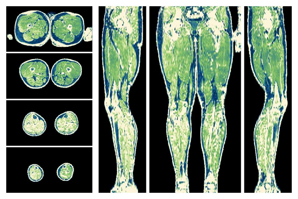 The R2 star relaxation time of the lower extremity obtained from the dixon reconstruction for muscle water fat quantification.