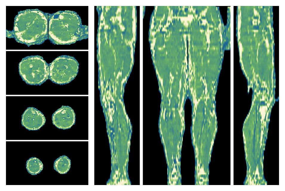 The water only T2 relaxation time of the lower extremity obtained from multi echo spin echo t2 mapping with EPG based reconstruction.