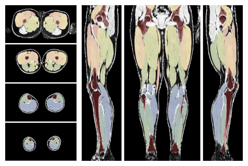 Overlay of automated muscle segmentation labels on dixon water image.