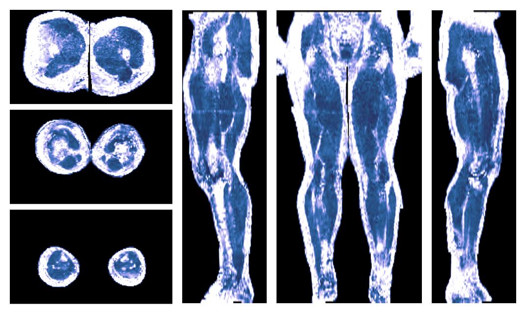 IVIM corrected whole leg muscle fractional anisotropy obtained from diffusion tensor imaging.