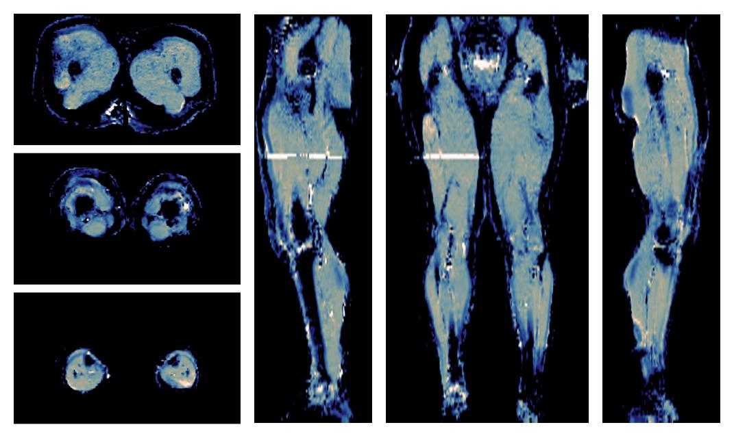 IVIM corrected whole leg muscle mean diffusivity obtained from diffusion tensor imaging.