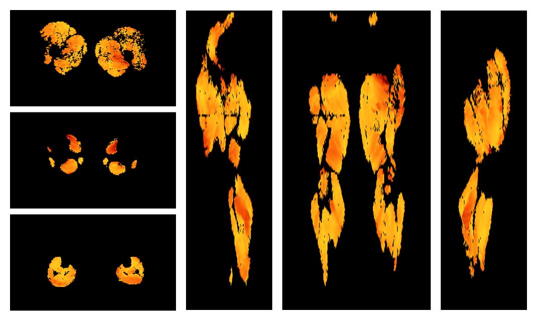 Muscle fiber tract angle map based on whole leg DTI based fiber tractography.