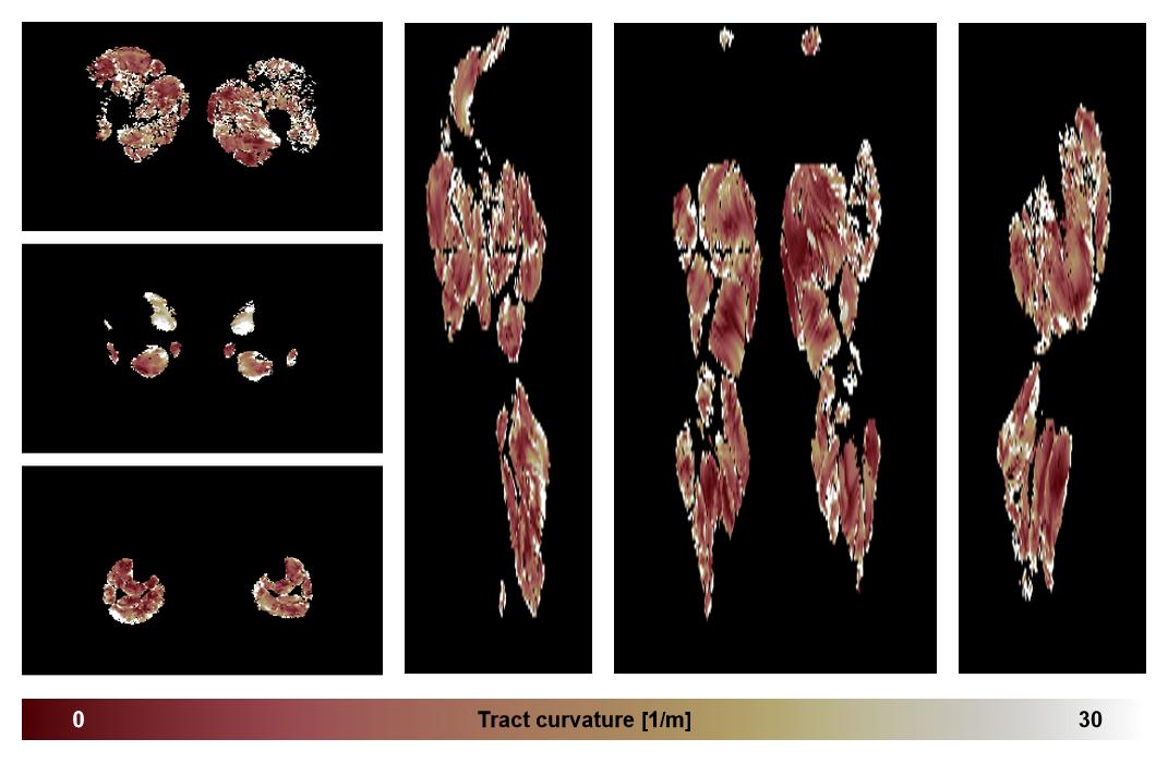 Muscle fiber tract curvature map based on whole leg DTI based fiber tractography.