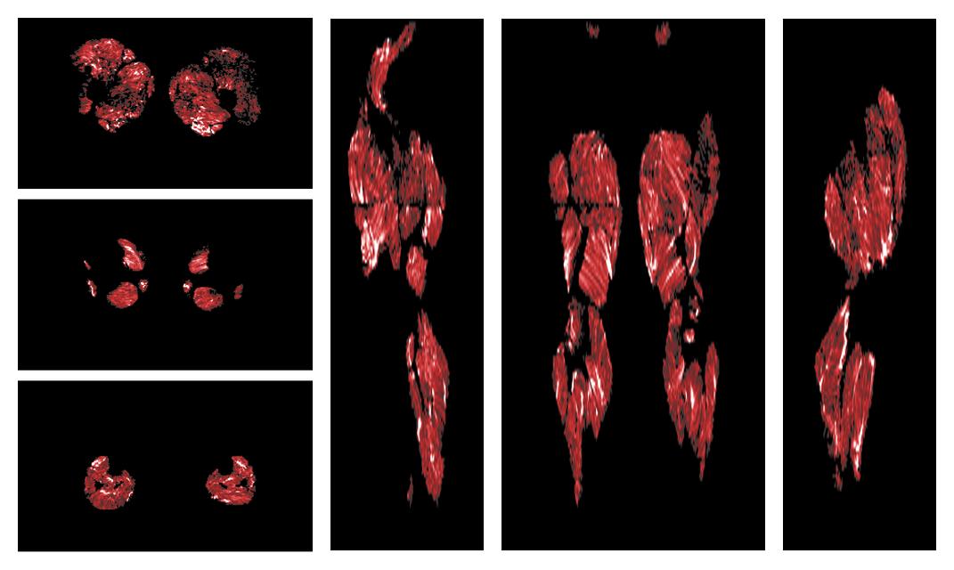 Muscle fiber tract density map based on whole leg DTI based fiber tractography.